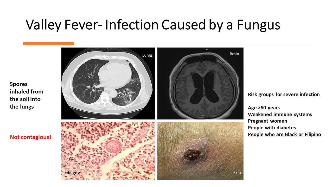 Up Close UCSF Fresno Infectious Diseases Specialist Helps Promote